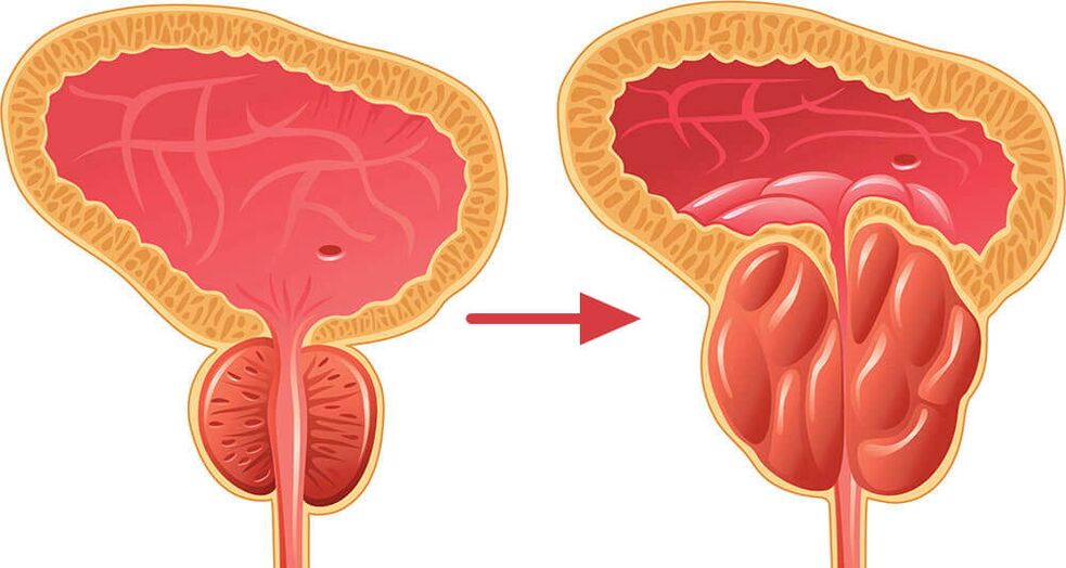 Glande de la prostate normale et enflée