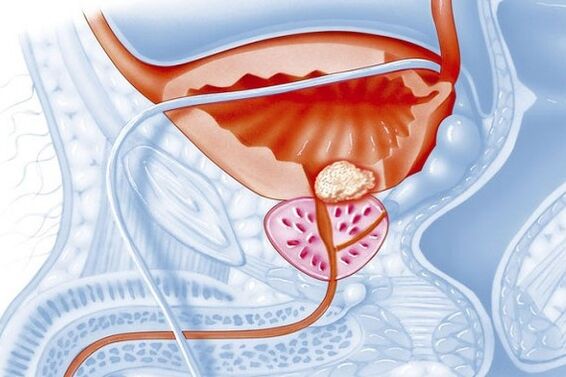 Processus inflammatoire dans la prostate.