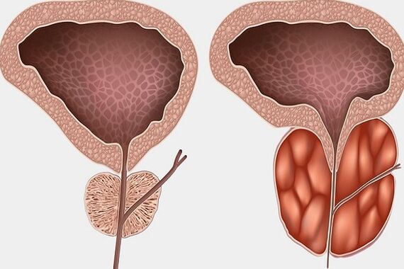 inflammation de la prostate