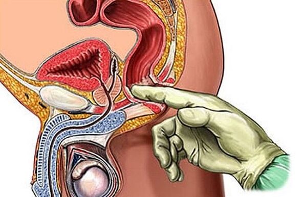 Massage de la prostate comme moyen de traiter la prostatite.