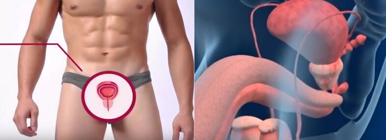 Prostatite chez l'homme, reconnaissable à certains signes.
