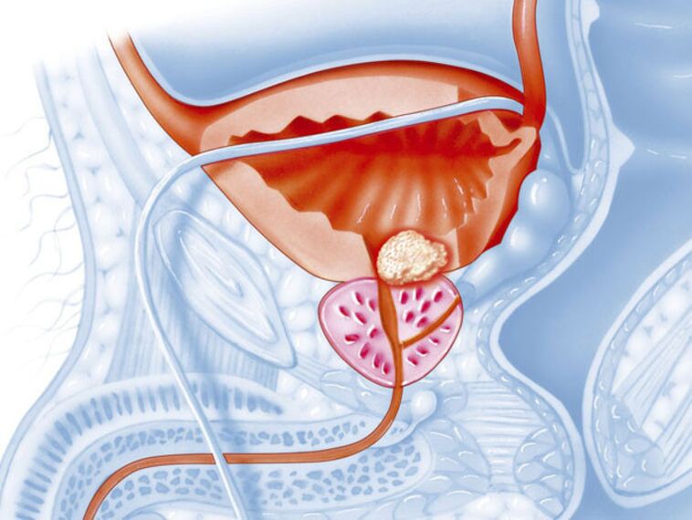 Dans la prostatite chronique, la lumière de l'urètre est rétrécie, ce qui rend difficile l'écoulement de l'urine. 